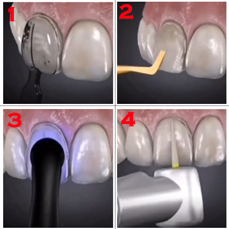 Dental Mould For Composite Res - Teeth Whitening Moulds review and price