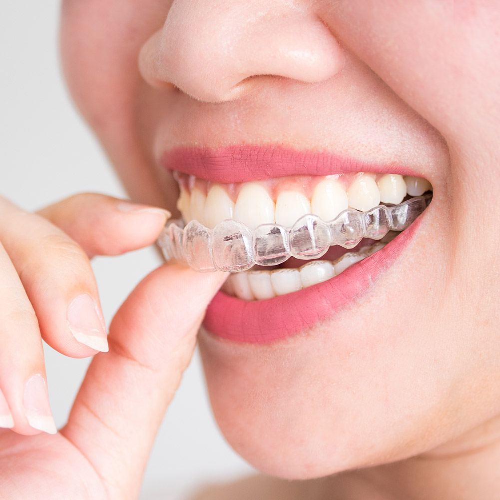 2/4pcs Mouth Guard Teeth Prote - Teeth Whitening With Braces review and price